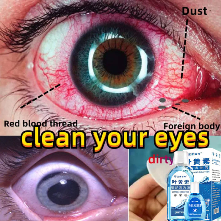 Medical Eye Wash Solution For Dry Itchy Eye Relief Eye Fatigue Blurred Vision Treatment Eye Care
