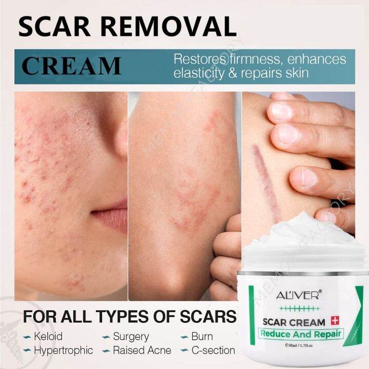 【Hot sale】 ALIVER Scar Remover Cream baby cream New Old Scars/acne ...