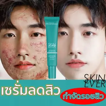 ครีมลดสิวหัวดำ ราคาถูก ซื้อออนไลน์ที่ - ก.ค. 2023 | Lazada.Co.Th