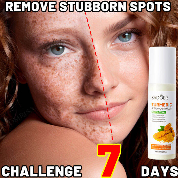 Turmeric Melasma and Pekas Remover Cream 120ML Japanese Melasma Cream Yunnan Herbal Whitening