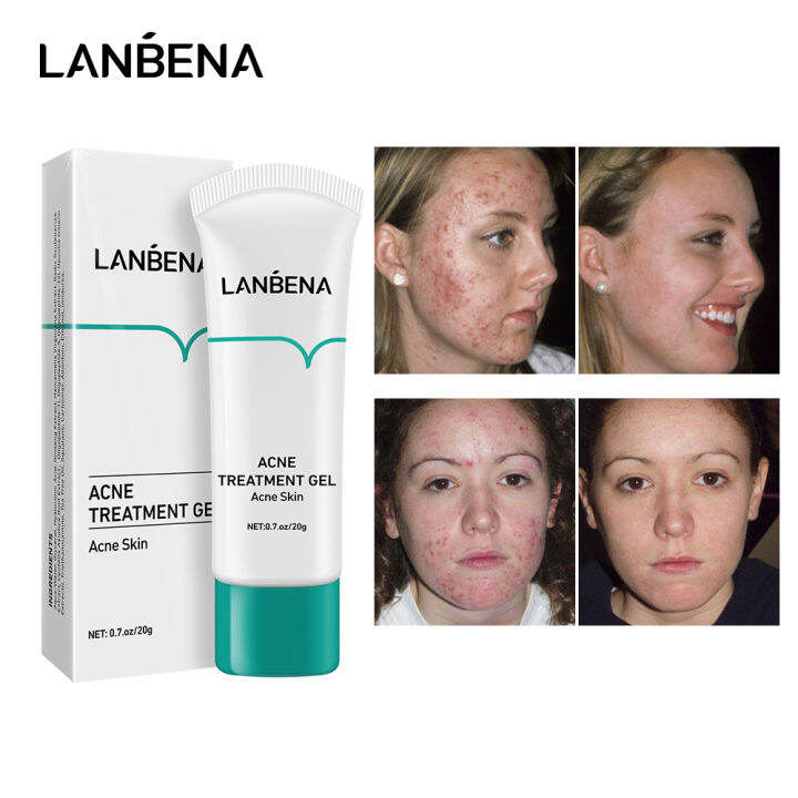LANBENA Herbal Acne Treatment Gel Acne Pimples Remover Cream Reduce