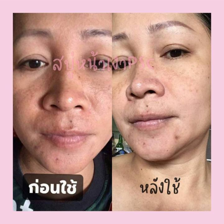 สบู่หน้าเงา-ฝ้าไม่มี-สิวไม่เกิด-ของแท้-100