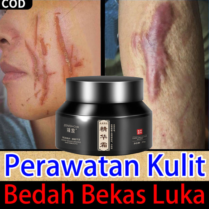 Krim Bekas Luka Esensi Krim Penghilang Penghapus Bekas Luka Untuk Wajah