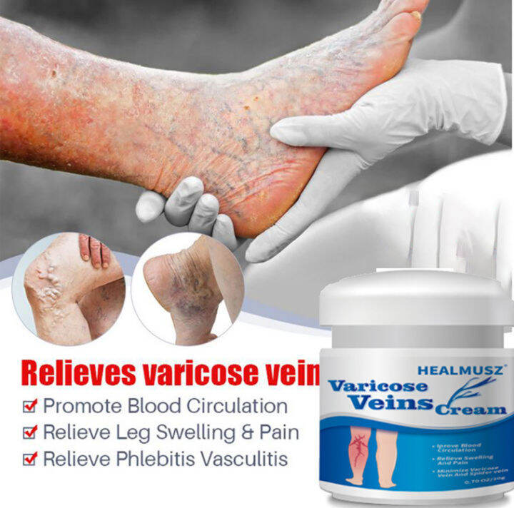 Varicose Vein Cream Natural Herbal Relieves Varicose Veins Eliminate