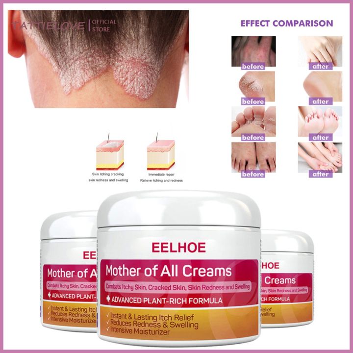 EELHOE Psoriasis Cream Psoriasis Treatment Cream Psoriasis Eczema Cream ...