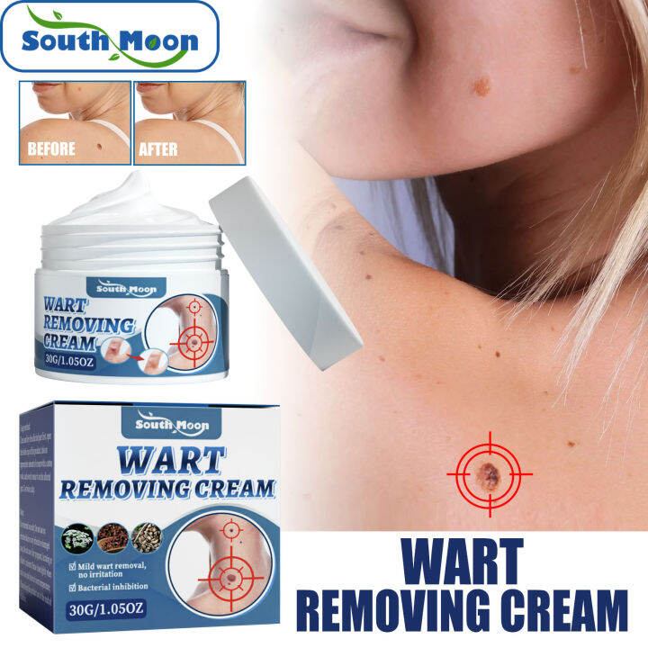 South Moon Wart Removing Cream No Irritation Bacterial Skin Tag Remover