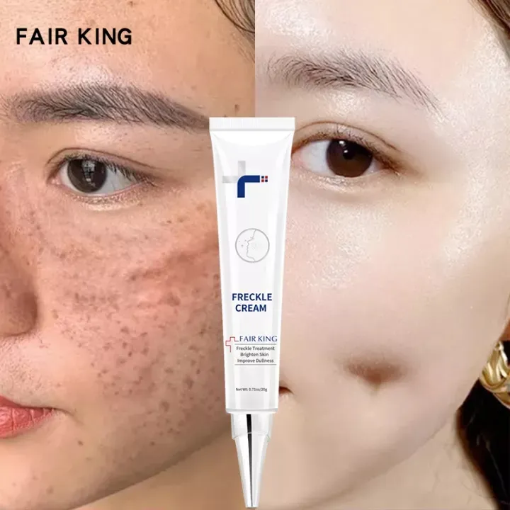 Effective Freckle Cream Remove Dark Spots Witening Cream Fade Acne Scars Melasma Anti Aging Skin