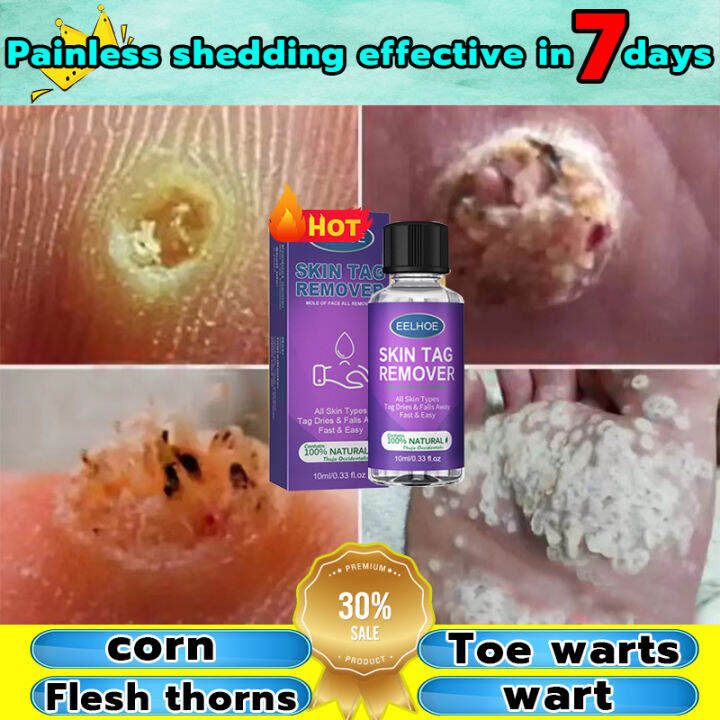 【COD 】10ml Warts Remover Original Cream Warts Magic Remover Wart ...