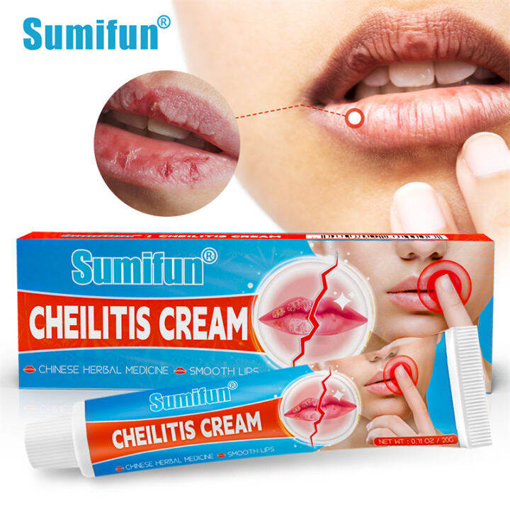 Sumifun 1Pc Cold Sores Lip Cheilitis Treatments Cream Herpes
