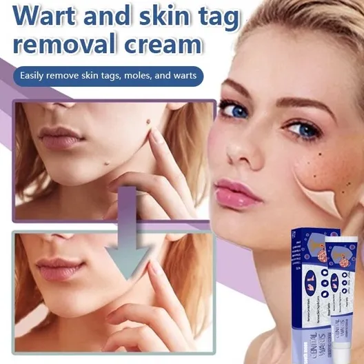 Super-life Warts And Mole Removal Ointment Wart Treatment Skin Tags 