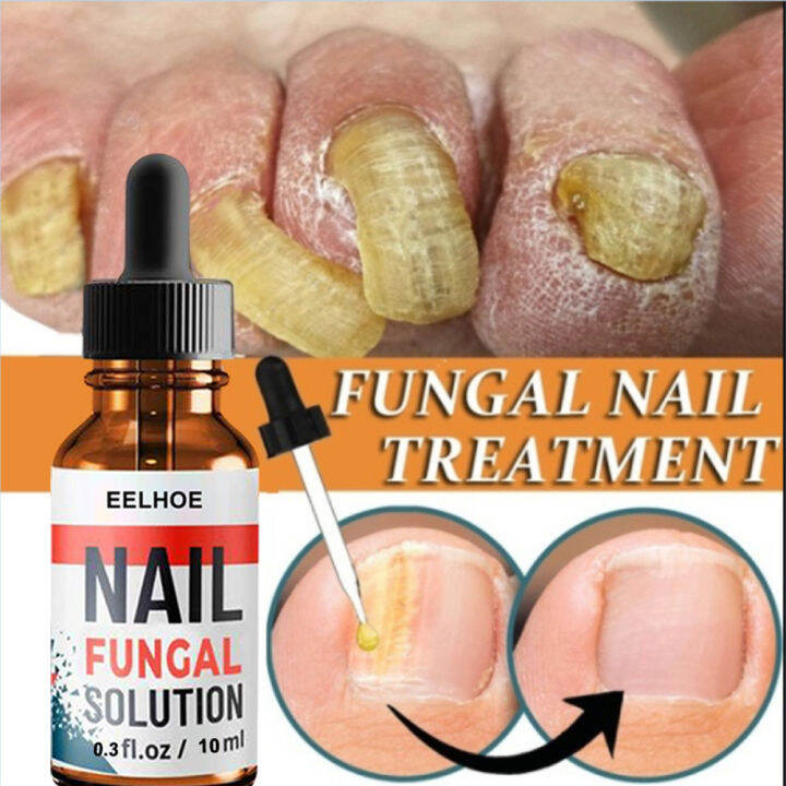 Eelhoe Nail Fungal Solution Foot Nail Fungus Removal Gel Antiinfective