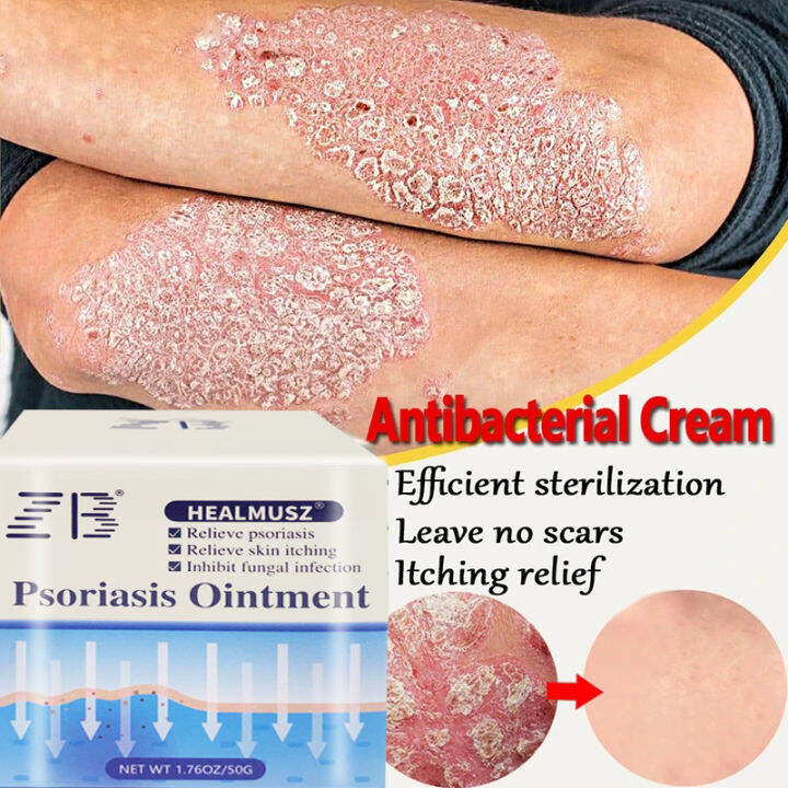 Seborrhoeic Dermatitis Eczema Psoriasis Treatment Ointment Effective