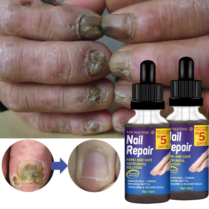 How To Fix And Prevent A Broken Nail — Expert Advice Allure | Nail Repair  Gel Quickly Improves The Appearance Of Infected Cracked Nails |  