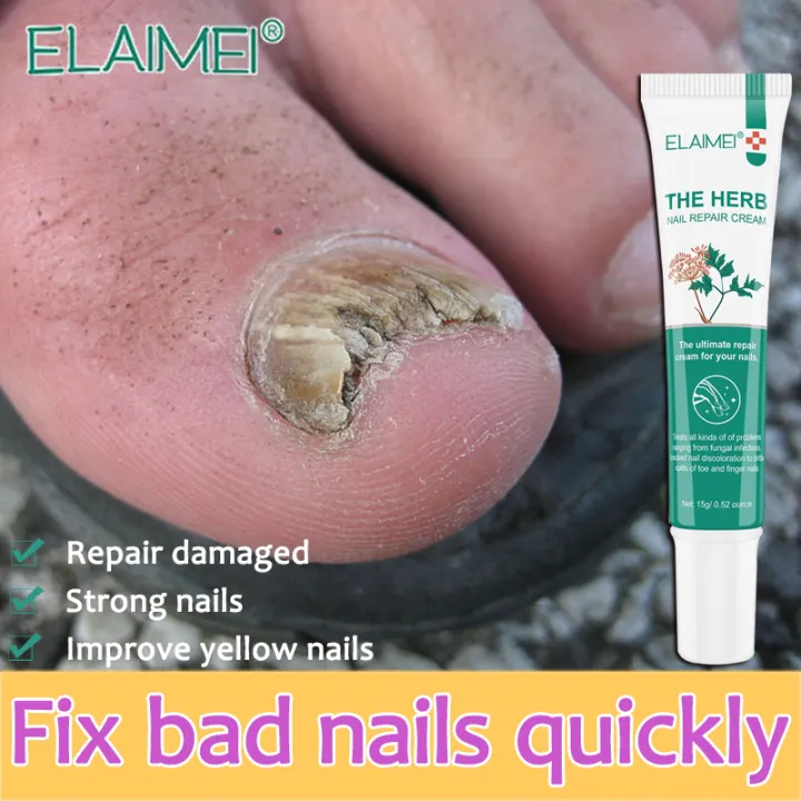 ELAIMEI nail fungus treatment the herb nail repair cream nail treatment fungal nail repair treatment nail ELAIMEI nail fungus treatment the herb nail repair cream nail treatment fungal nail repair treatment nail