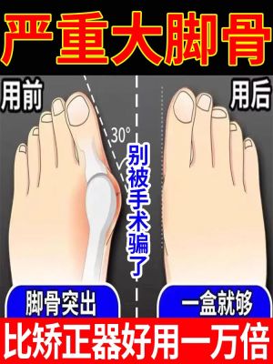 Big Foot [Running Up] Toe Valgus Correction Artifact Great Toe Deformation Anti-wear Mens and Womens Foot Special Patch