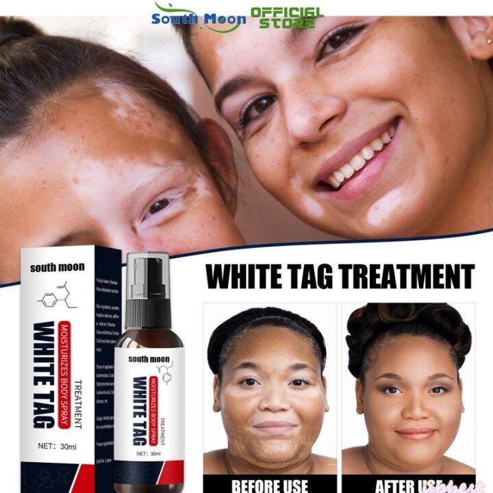 South Moon Vitiligo Treatment Cream Mustard Oil For Vitiligo Remover