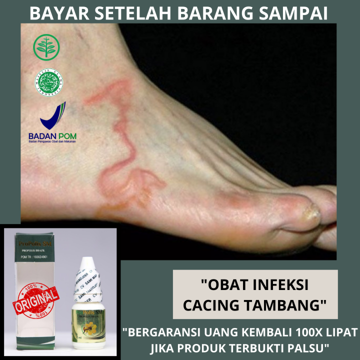 Obat Infeksi Cacing Tambang - Obat Cacing Tambang, Obat Cacing Kremi ...