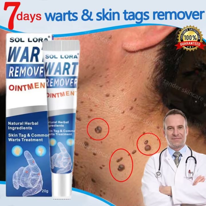 Warts Remover Original Watson Cream Painless Warts Removal Skin Tags ...