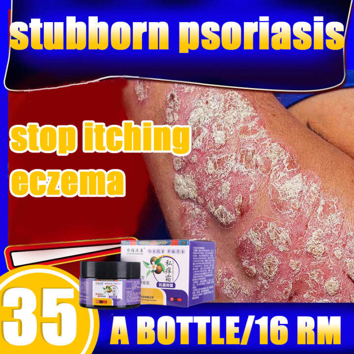 Psoriasis antiseptic cream eczema antipruritic antiseptic Antibacterial