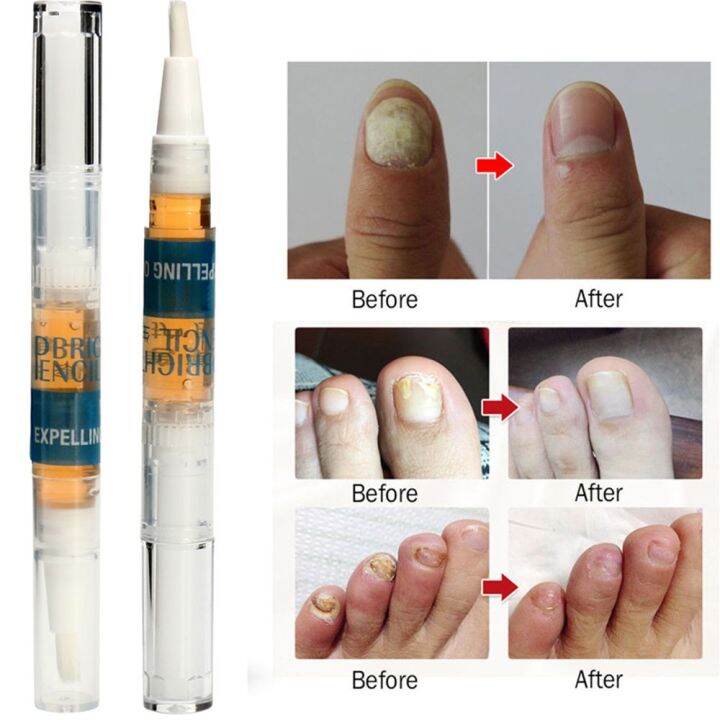 NOUTURE Beauty Finger Herbal Feet Toe Repair Nail care Fungus Remove
