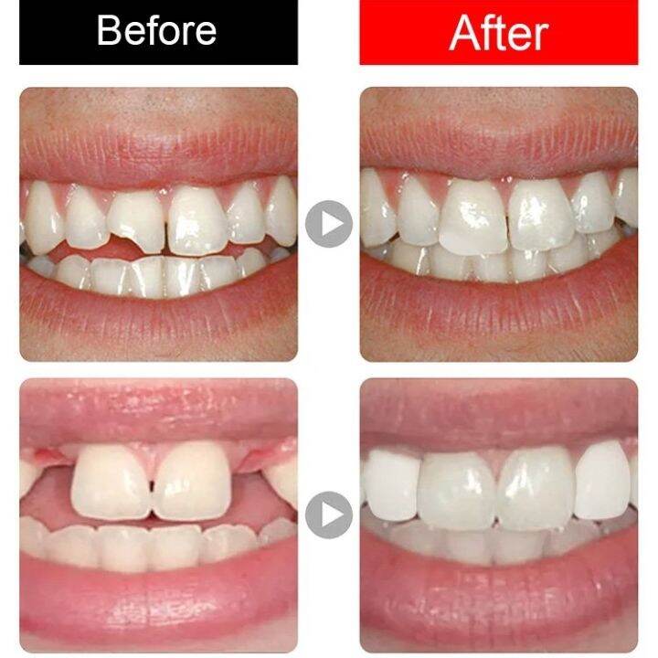 SuperLife [Epoxy Resin] Temporary dentures modified solid tooth gel