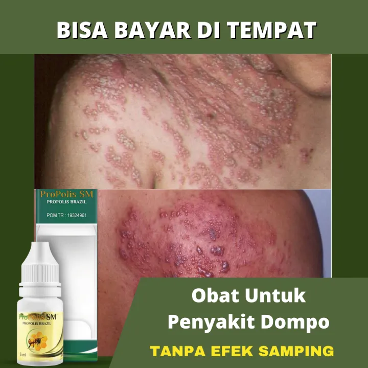 Propolis Brazil SM - Obat Penyakit Dompo - Herpes zoster, Penyakit