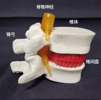 Medical human lumbar intervertebral disc model is prominent pathological presentation spinal vertebrae joint standard model