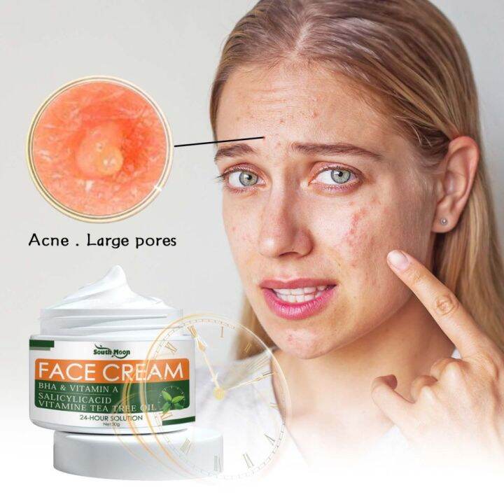 Acne Remover Cream Pimple Marks Remover Cream Acne Treatment 30g