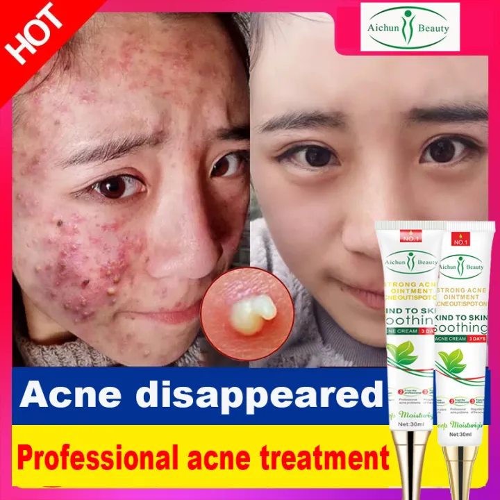 Acne Killer！ Aichun Acne Cream 30ml It can remove acne marks, acne ...