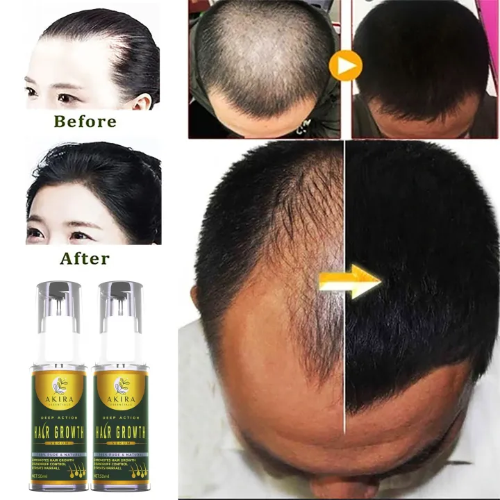 2 bottles Akira Hair Growth Serum with Powerful ALL Natural Ingredients Proven Hair Growth Serum Fast Powerful Hair Grower Hair Care 100% Pure Natural Treatment Hair Loss Treatment Hair | Lazada PH 2 bottles Akira Hair Growth Serum with Powerful ALL Natural Ingredients Proven Hair Growth Serum Fast Powerful Hair Grower Hair Care 100% Pure Natural Treatment Hair Loss Treatment Hair | Lazada PH