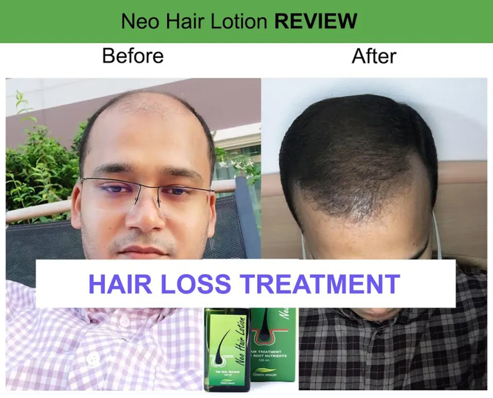 Share more than 125 neo hair lotion review super hot camera.edu.vn