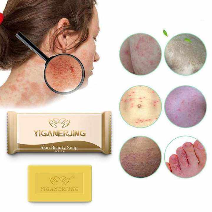 Sulfur Soap Skin Deep Cleansing Acne Seborrhea Antifungal Bath Anti