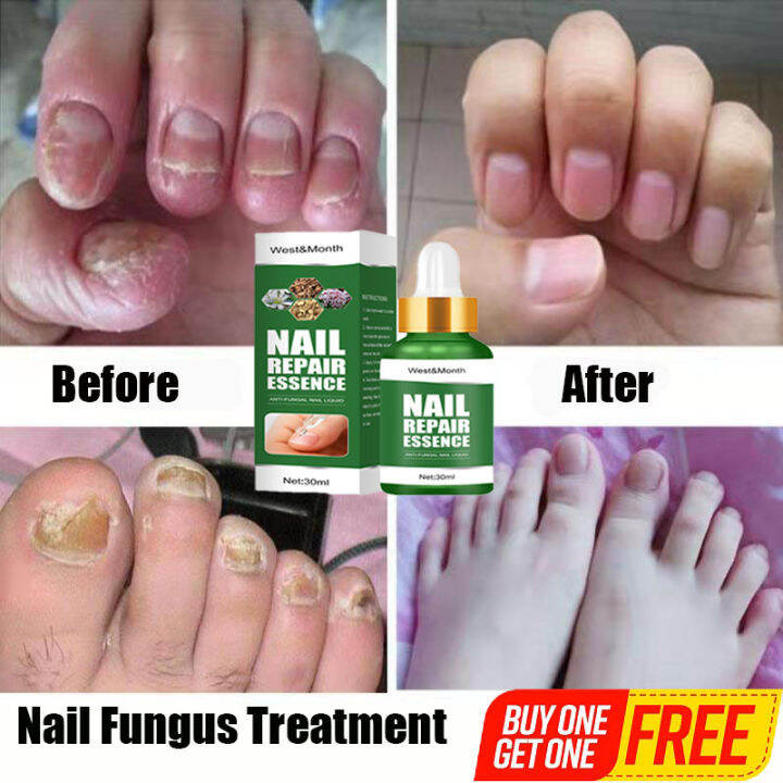 [buy one get one free] Nail care Nail repair essence Nail treatment