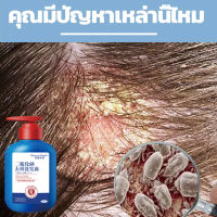 ป้องกันรังแคและคัน ไม่ทำร้ายหนังศีรษ แชมพูขจัดรังแค300ml ควบคุมความมัน ขจัดรังแค บำรุงรากผม ลดผมร่วง（ดูแลหนังศีรษะ แชมพู แชมพูรักษารังแค ยาสระผมเชื้อรา แชมพูแก้ผมหงอก บำรุงหนังศีรษะ ยาสระผมแก้เชื้อรา แชมพูคัน ลดรังแค ยาสระผม ยาสระผมเชื้อรา มีรังแค）