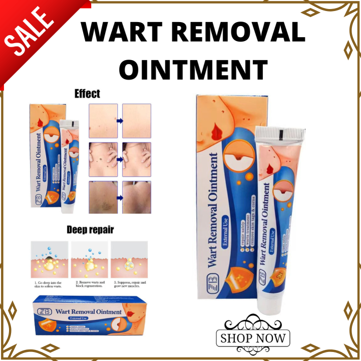 100% Effective Warts Removal Ointment Wart Remover Warts Remover ...