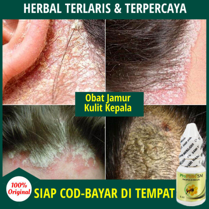 Obat Infeksi Jamur Kepala Mikosis Tinea Capitis Kurap Dermatitis Seboroik Obat Kulit Kepala