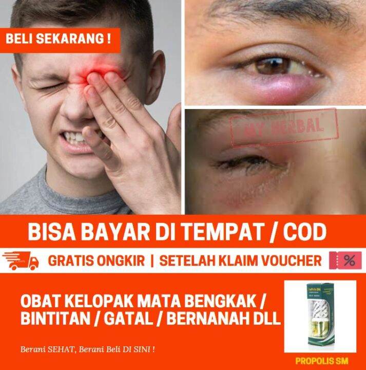 PROPOLIS SM OBAT ALAMI UNTUK BINTITAN, MATA BINTITAN DI BAWAH MATA ...