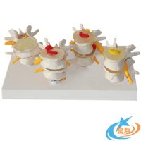 Star life of brand 4 stages model of intervertebral disc herniation lumbar lesions model lumbar spine model