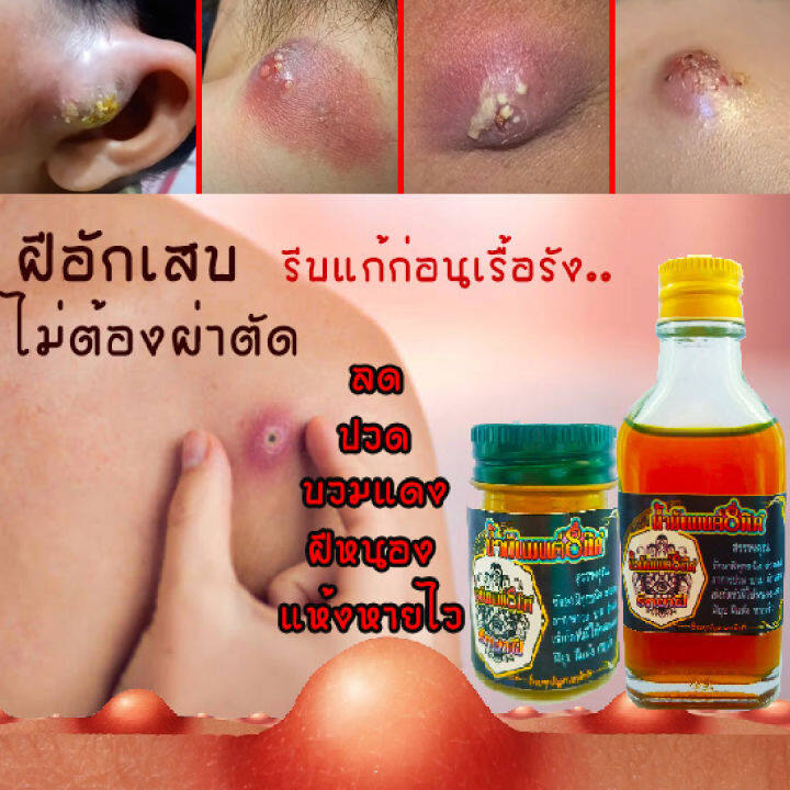 ครีมทาฝี-หัวฝีหนอง-หัวฝีอักเสบ-ฝีแตก-ฝีที่อยู่บนผิวหนังตามร่างกาย-ตราน้ำมันมนต์8ทิศ-กระปุกใหญ่-ออร์แกนิก