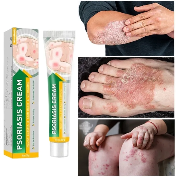 Psoriasis Antibacterial Cream Sultry Itching Scalp Ringworm Eczema