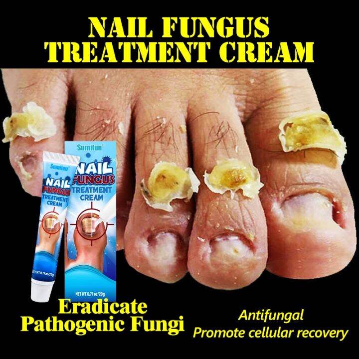 【Fast-acting and Effective】Nail Fungus Treatment Nail Repair Remove ...