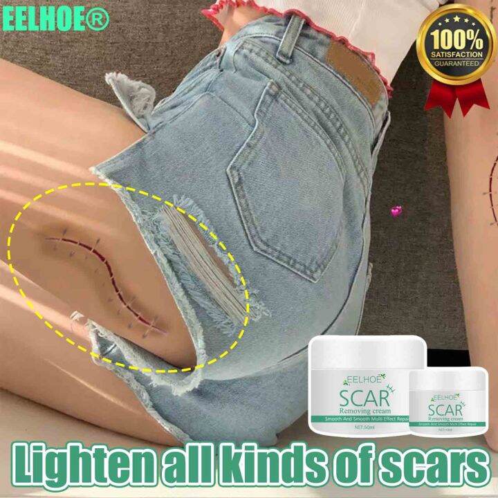 Scar Remover【150g】 For Old Scar On Leg Eelhoe Scar Removal Cream Facial Scar Repair Old Scar 5316