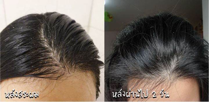 ของแท้-100-แชมพู-ขจัดรังแค-เห็นผลตั้งแต่ครั้งแรกที่ใช้-yves-rocher-bhc-v2-anti-dandruff-treatment-shampoo-300ml-แชมพูสำหรับผู้มีปัญหารังแค-คันศีรษะ