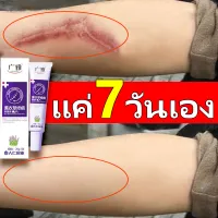 ลบรอยแผลเป็น รอยสิว Scar cream แผลไฟไหม้ ครีมลดรอยแผล ครีมทารอยแผลเป็น ครีมทาแผลเป็น ครีมลบแผลเป็น แผลเป็น ครีมรอยแผลเป็น ครีมลดแผลเป็น รอยแผลเป็น เจลลบรอยแผลเป็น ครีมซ่อมแซม แผลน้ำร้อนลวก ครีมรักษาแผลเป ลดเลือนรอยแผลเป็น ครีมป้องกันรอยแผลเป็น