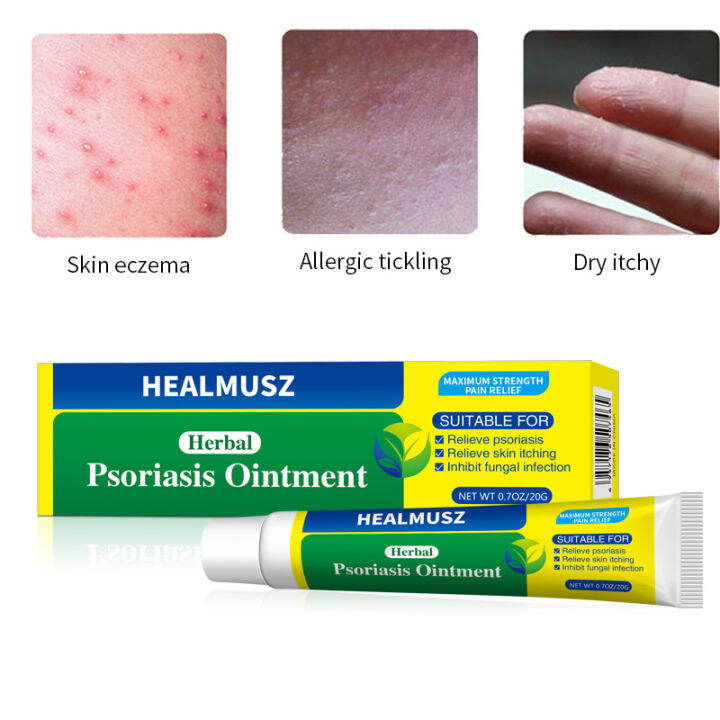 Skin Psoriasis Cream Dermatitis Eczema Pruritus Foot Eczema Rash Skin ...