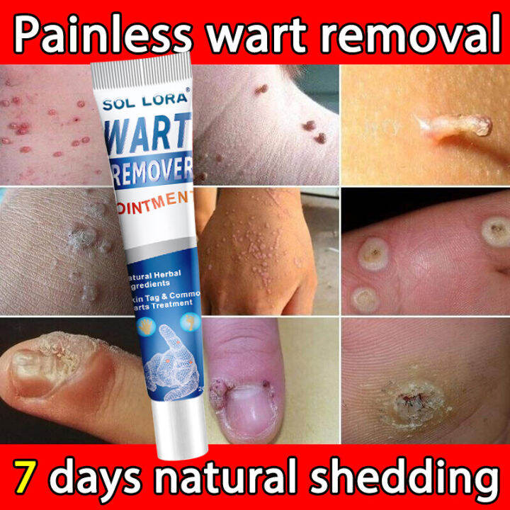 Original Wart Removal Cream 20g Removes Various Common Warts Painless