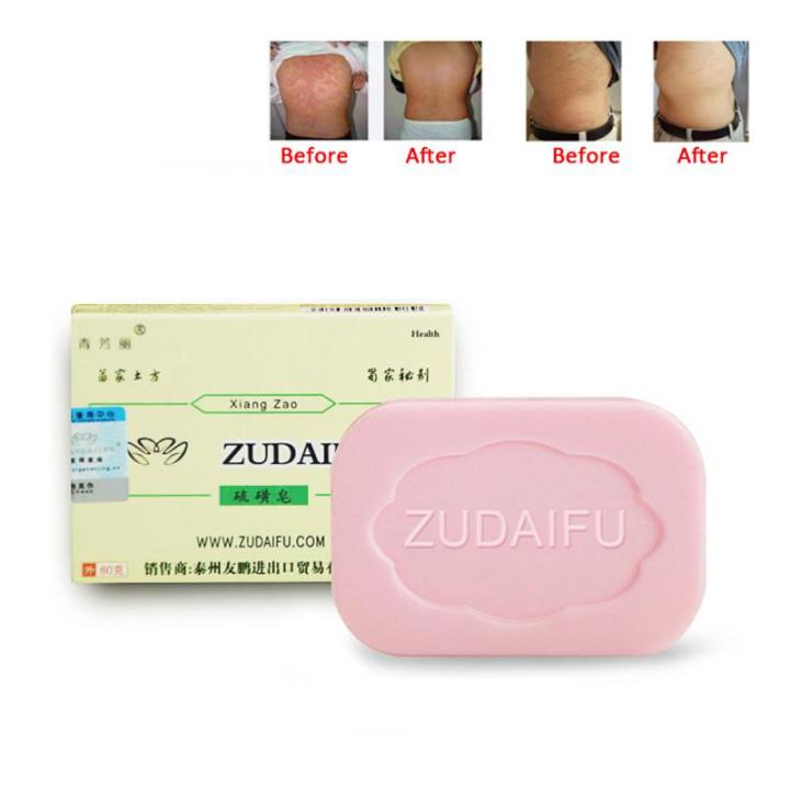 zudaifu-กำมะถันซัลเฟอร์สบู่ซ่อมแซมผิวสิวโรคสะเก็ดเงิน-seborrhea-กลากป้องกันเชื้อราอาบน้ำไวท์เทนนิ่งแชมพูโรคสะเก็ดเงินครีม
