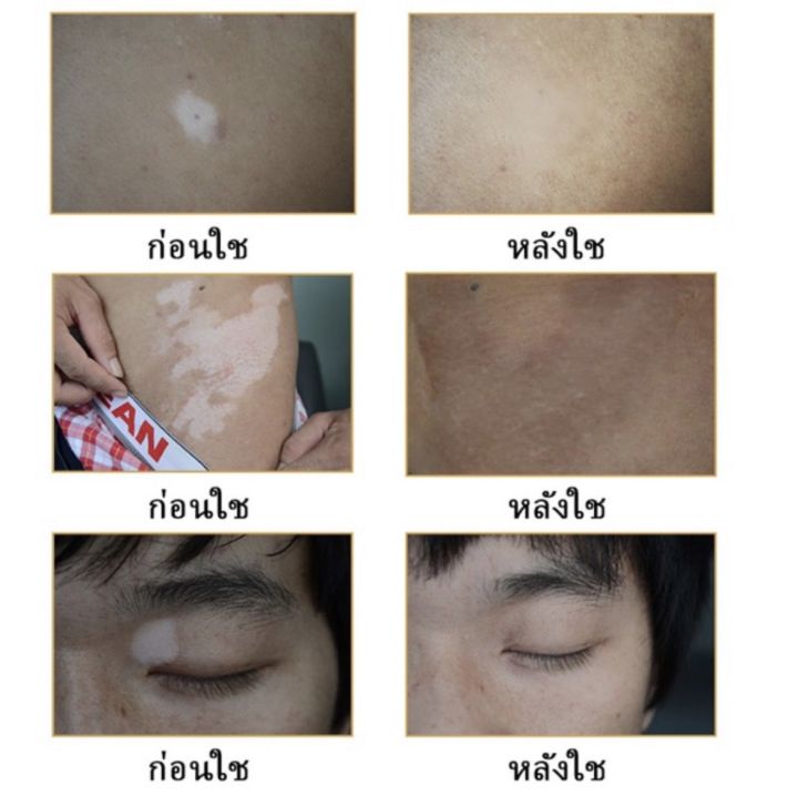 herbal-extract-vitiligo-ส่งทันที-south-moon-ครีมทาด่างขาว-ด่างขาวที่หน้า-ด่างขาวที่หลัง-ด่างขาวที่แขน-ด่างขาวที่ตัว