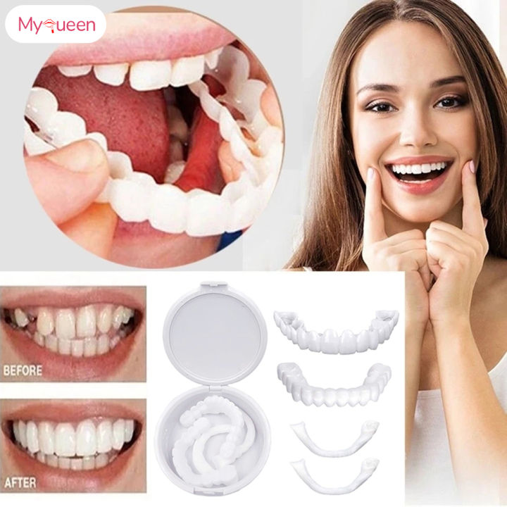 MyQueen Whitening Dentures Simulation Braces Fake Snap-On White Upper ...