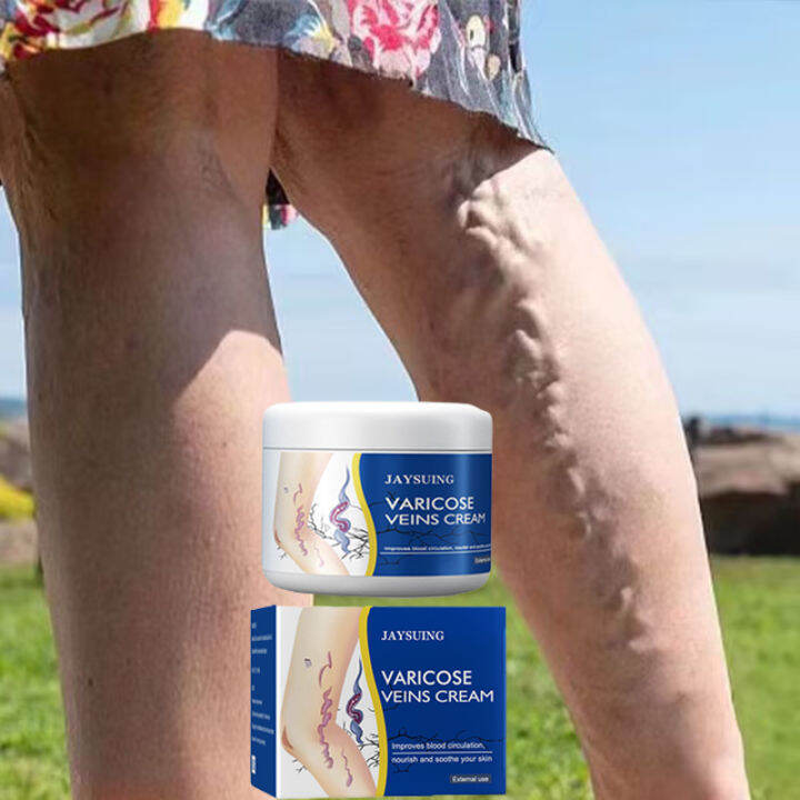 7 Days Effective Varicose Vein Treatment Cream Spider Vein Pain 7 days effective varicose vein treatment cream spider vein pain